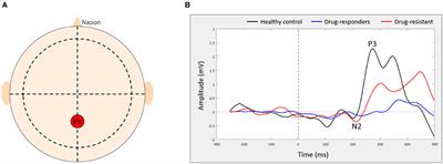 Limited Ability to Adjust N2 Amplitude During Dual Task Walking in People With Drug-Resistant Juvenile Myoclonic Epilepsy